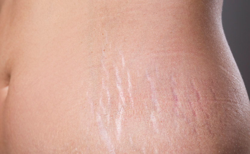 Striae and Scar Treatments